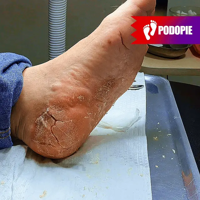 PIE DE ATLETA