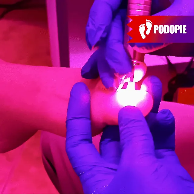 TRATAMIENTO LASER